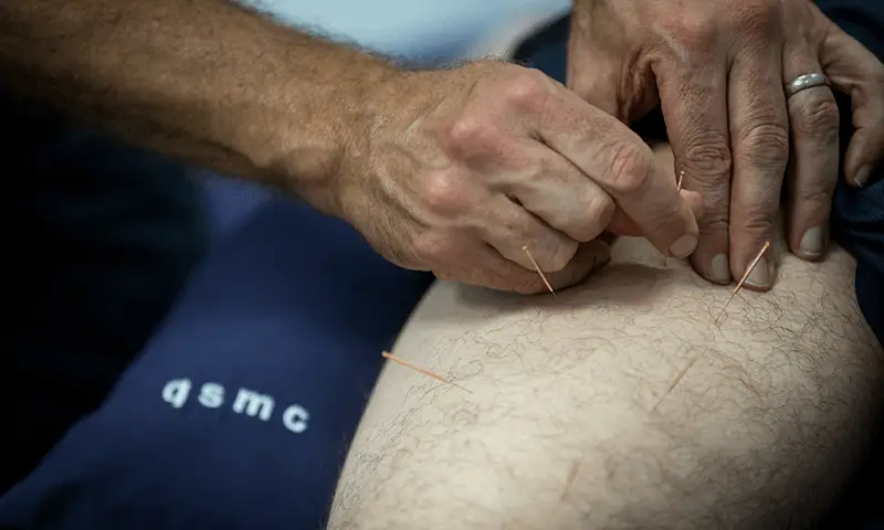 A client receiving dry needling treatment at the QSMC clinic