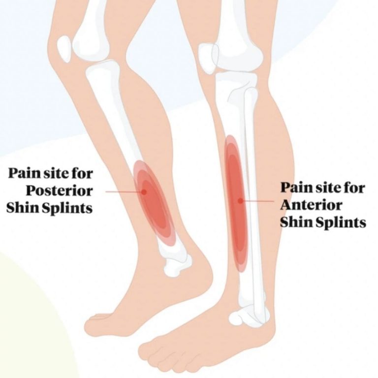 Can Shin Splints Cause Leg Numbness At Georgia Challis Blog